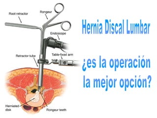 ¿es la operación Hernia Discal Lumbar la mejor opción? 
