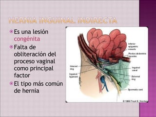 Es una lesión  congénita Falta de obliteración del proceso vaginal  como principal factor El tipo más común de hernia 
