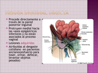 Procede directamente a través de la pared posterior inguinal Protruyen medial hacia las vasos epigástricos inferiores y no están asociados al proceso vaginal Lesiones  adquiridas Atribuidas al desgaste cotidiano  en pacientes ancianos(esfuerzo para toser, orinar, defecar, levantar objetos pesados) 