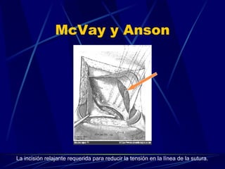 Mcvay Incision Hernia Inguinal | PPT