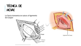 Mcvay Incision hernia-inguinal -hernia-inguinal-hernia-inguinal | PPTX