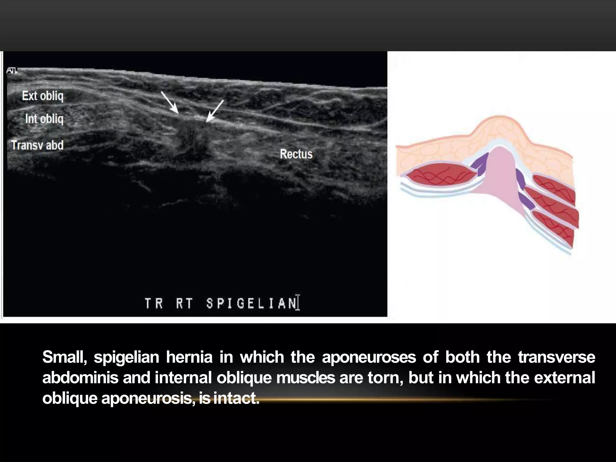 Ultrasound of Hernia | PPTX
