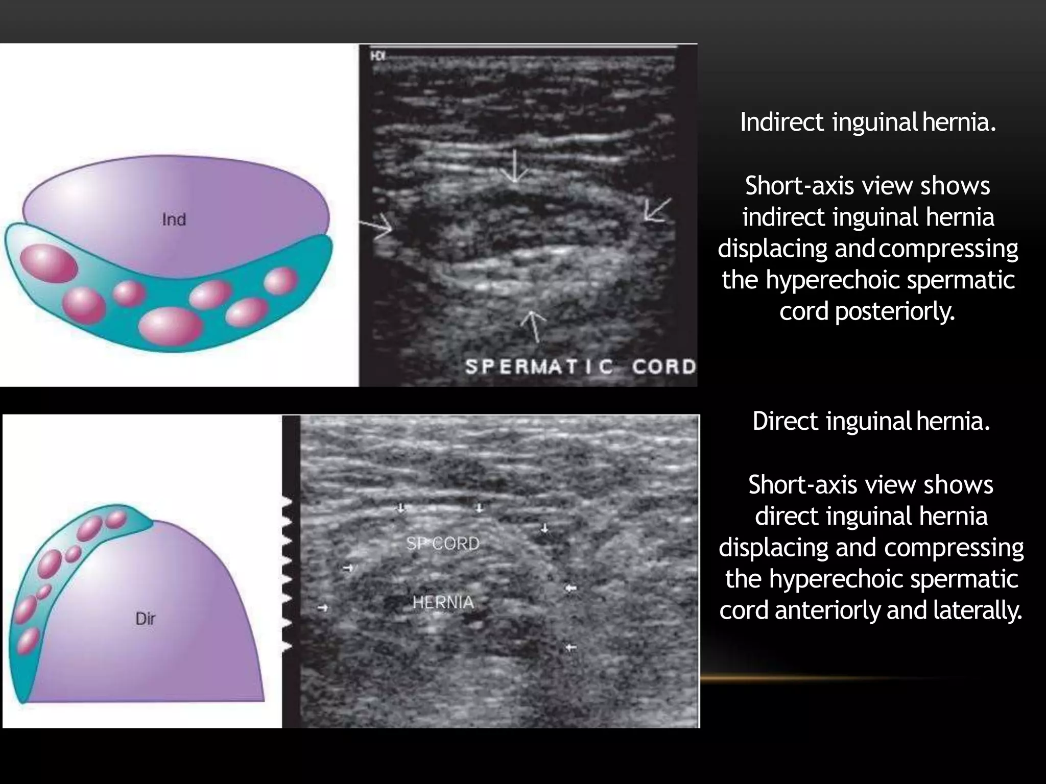 Indirect vs direct inguinal hernia short-axis USG - spermatic cord displacement