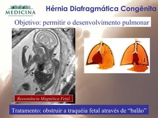 Hérnia Diafragmática Congênita
Ressonância Magnética FetalRessonância Magnética Fetal
Objetivo: permitir o desenvolvimento pulmonar
Tratamento: obstruir a traquéia fetal através de “balão”
 
