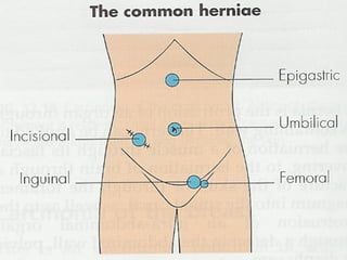 Hernia[1] | PPT