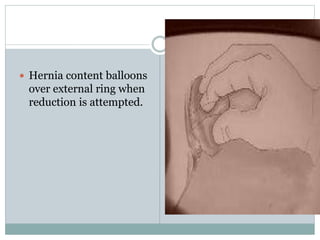  Hernia content balloons
over external ring when
reduction is attempted.
 