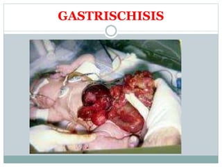 GASTRISCHISIS
 