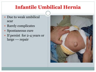 Infantile Umbilical Hernia
 Due to weak umbilical
scar
 Rarely complicates
 Spontaneous cure
 If persist for 2-4 years or
large --- repair
 