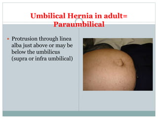 Umbilical Hernia in adult=
Paraumbilical
 Protrusion through linea
alba just above or may be
below the umbilicus
(supra or infra umbilical)
 