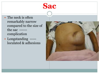 Sac
 The neck is often
remarkably narrow
compared to the size of
the sac ------
complication
 Longstanding -----
loculated & adhesions
 