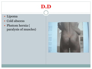 D.D
 Lipoma
 Cold abscess
 Phntom hernia (
paralysis of muscles)
 