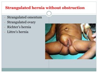 Strangulated hernia without obstruction
- Strangulated omentum
- Strangulated ovary
- Richter’s hernia
- Littre’s hernia
 