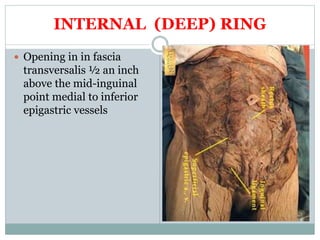 INTERNAL (DEEP) RING
 Opening in in fascia
transversalis ½ an inch
above the mid-inguinal
point medial to inferior
epigastric vessels
 