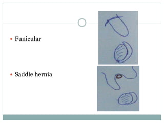  Funicular
 Saddle hernia
 