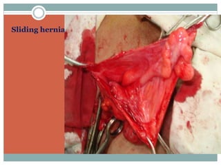 Sliding hernia
 