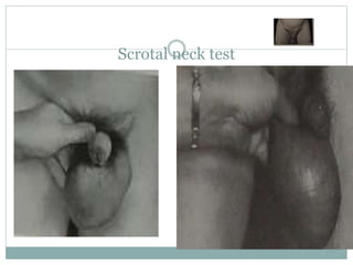 Scrotal neck test
 