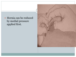  Hernia can be reduced
by medial pressure
applied first.
 
