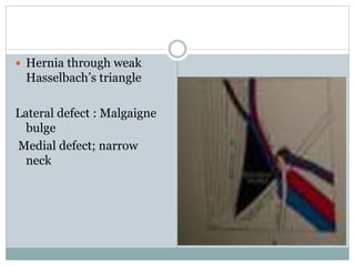  Hernia through weak
Hasselbach’s triangle
Lateral defect : Malgaigne
bulge
Medial defect; narrow
neck
 