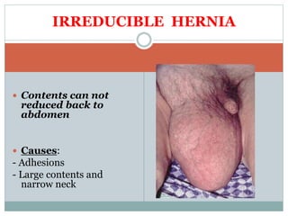  Contents can not
reduced back to
abdomen
 Causes:
- Adhesions
- Large contents and
narrow neck
IRREDUCIBLE HERNIA
 