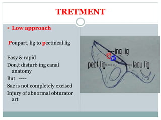 TRETMENT
 Low approach
Poupart, lig to pectineal lig
Easy & rapid
Don,t disturb ing canal
anatomy
But ----
Sac is not completely excised
Injury of abnormal obturator
art
 