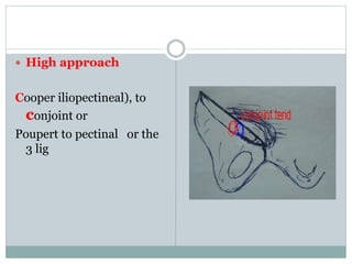  High approach
Cooper iliopectineal), to
conjoint or
Poupert to pectinal or the
3 lig
 