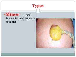Types
Minor --- small
defect with cord attach to
its center
 