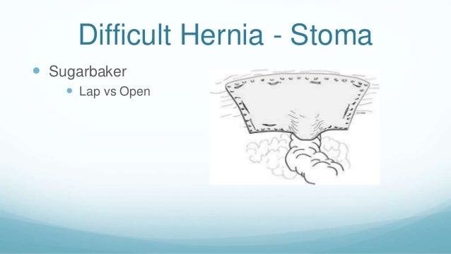Hernia and Abdominal Wall Reconstruction: Peri-Operative ...