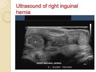 Ultrasound of right inguinal
hernia

 