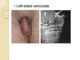 . Left-sided varicocele

 