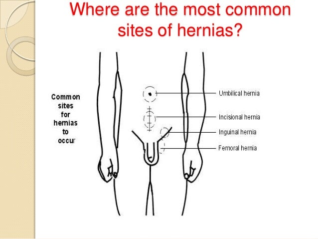 herniorrhaphy
