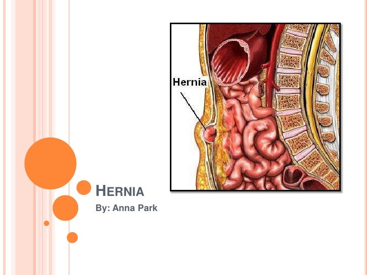 Hernia