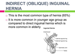 INDIRECT (OBLIQUE) INGUINAL
HERNIA
 This is the most common type of hernia (65%)
 It is more common in younger age group as
compared to direct inguinal hernia which is
more common in elderly
 