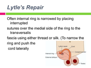 Lytle’s Repair
Often internal ring is narrowed by placing
interrupted
sutures over the medial side of the ring to the
transversalis
fascia using either thread or silk. (To narrow the
ring and push the
cord laterally
 