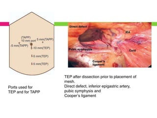 Ports used for
TEP and for TAPP
TEP after dissection prior to placement of
mesh.
Direct defect, inferior epigastric artery,
pubic symphysis and
Cooper’s ligament
 