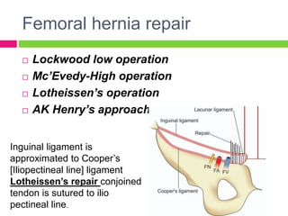 Femoral hernia repair
 Lockwood low operation
 Mc’Evedy-High operation
 Lotheissen’s operation
 AK Henry’s approach
Inguinal ligament is
approximated to Cooper’s
[Iliopectineal line] ligament
Lotheissen’s repair conjoined
tendon is sutured to ilio
pectineal line.
 