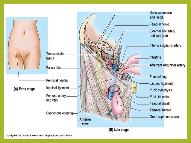 Femoral Hernia Cause Weight Loss