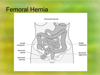 Femoral Hernia
 