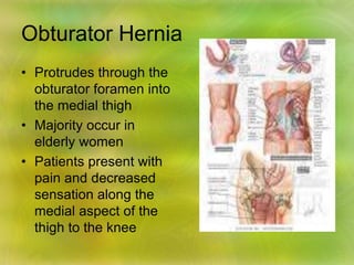Obturator Hernia
• Protrudes through the
obturator foramen into
the medial thigh
• Majority occur in
elderly women
• Patients present with
pain and decreased
sensation along the
medial aspect of the
thigh to the knee
 