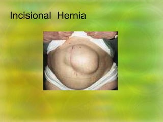 Incisional Hernia
 