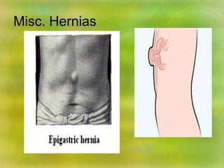 Misc. Hernias
 