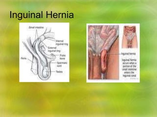 Inguinal Hernia
 
