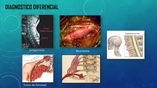 Siringomielia 
Neurinoma 
Tumor de Pancoast 
DIAGNOSTICO DIFERENCIAL  