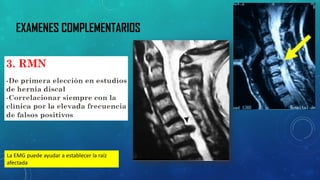 EXAMENES COMPLEMENTARIOS 
La EMG puede ayudar a establecer la raíz 
afectada 
 