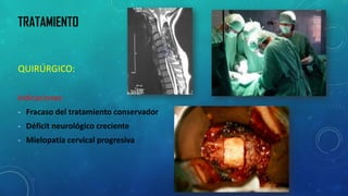 QUIRÚRGICO: 
Indicaciones: 
-Fracaso del tratamiento conservador 
-Déficit neurológico creciente 
-Mielopatíacervical progresiva 
TRATAMIENTO  