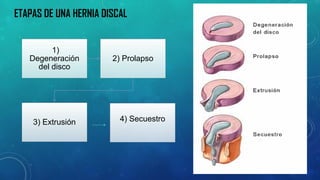 ETAPAS DE UNA HERNIA DISCAL 
1) Degeneración del disco 
2) Prolapso 
3) Extrusión 
4) Secuestro  