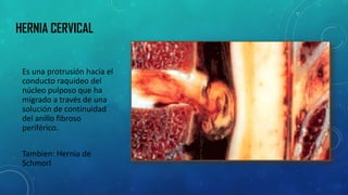 HERNIA CERVICAL 
Es una protrusión hacia el conducto raquídeo del núcleo pulposo que ha migrado a través de una solución de continuidad del anillo fibroso periférico. 
Tambien: Hernia de Schmorl  
