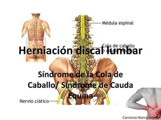 Herniación discal lumbar
Síndrome de la Cola de
Caballo/ Síndrome de Cauda
Equina
Carranza Ibarra Jazmín

 