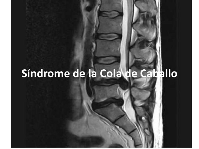 La curvatura de la columna vertebral el tratamiento spb