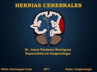 HERNIAS CEREBRALES
Dr. Josué Perdomo Rodríguez
Especialista en Imagenología
HGAL-Cienfuegos-Cuba 2017 Depto. Imagenología
 