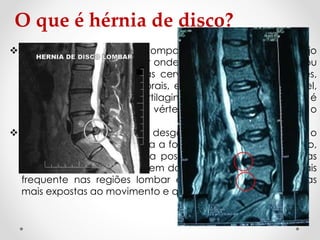 O que é hérnia de disco?
 A coluna vertebral é composta por vértebras, em cujo
interior existe um canal por onde passa a medula espinhal ou
nervosa. Entre as vértebras cervicais, torácicas e lombares,
estão os discos intervertebrais, estruturas em forma de anel,
constituídas por tecido cartilaginoso e elástico cuja função é
evitar o atrito entre uma vértebra e outra e amortecer o
impacto.
 Os discos intervertebrais desgastam-se com o tempo e o
uso repetitivo, o que facilita a formação de hérnias de disco,
ou seja, parte deles sai da posição normal e comprime as
raízes nervosas que emergem da coluna. O problema é mais
frequente nas regiões lombar e cervical, por serem áreas
mais expostas ao movimento e que suportam mais carga.
 